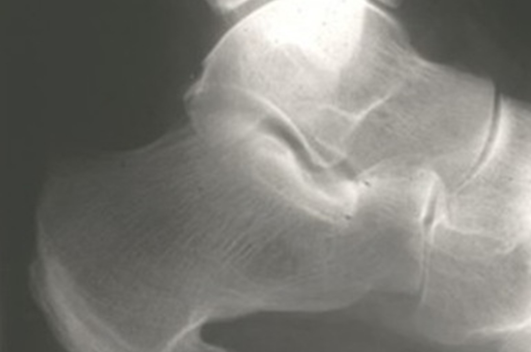 What is psoriatic arthritis.jpg