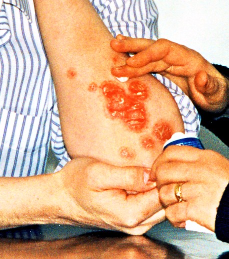 Treating psoriasis on arm.jpg