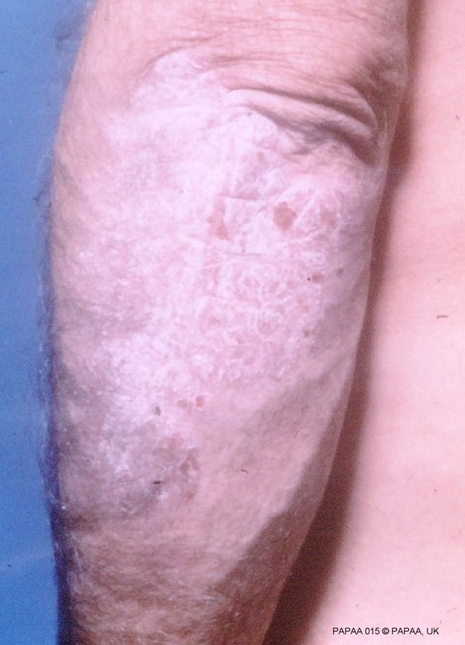 Plaque psoriasis on lower arm.jpg