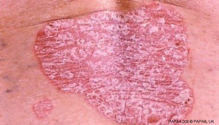 Plaque psoriasis lower back.jpg