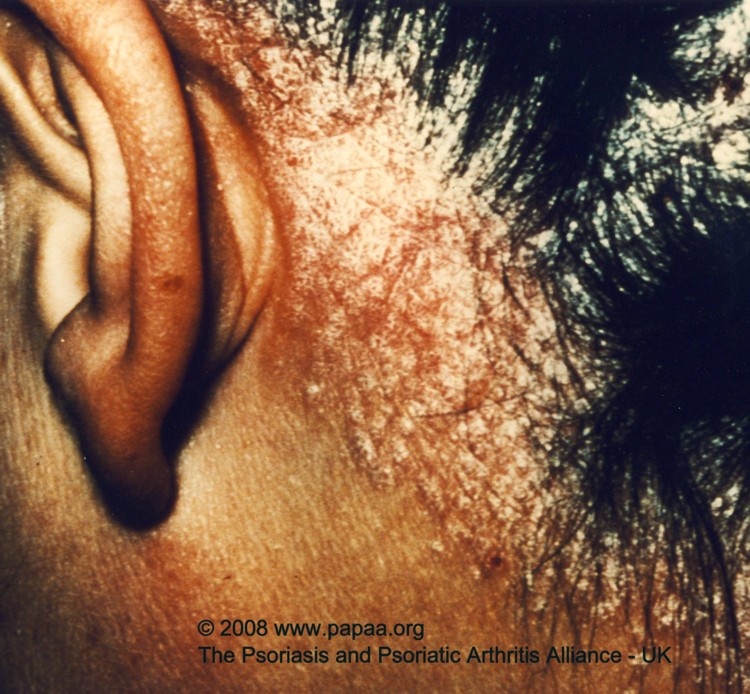 Scalp psoriasis 3.jpg