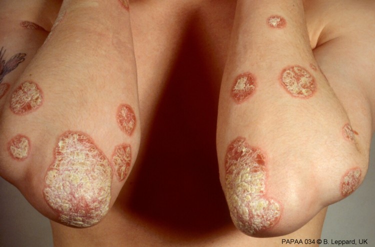 Plaque psoriasis on elbows and arms.jpg