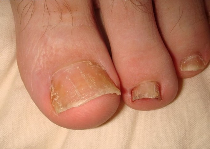 Nail psoriasis 10.jpg