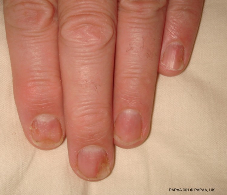 Nail psoriasis 1.jpg