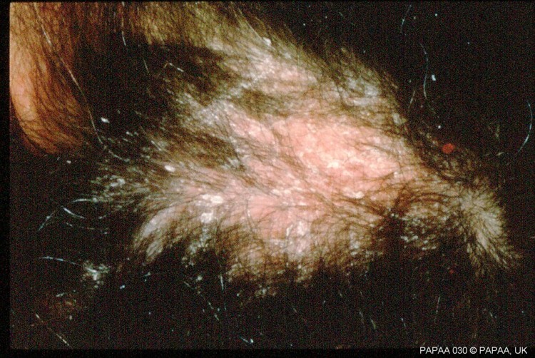 Scalp psoriasis 5.jpg