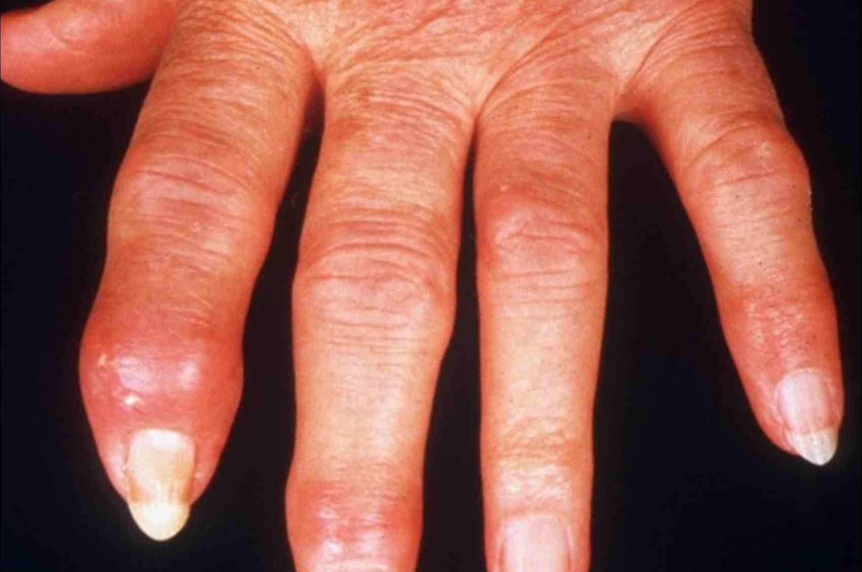 Psoriatic arthritis hands.jpg